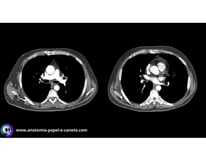 Mediastino por TC - Axial