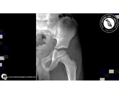 Ossos do quadril por rx - 2