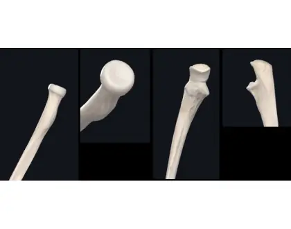 Rádio e Ulna proximal