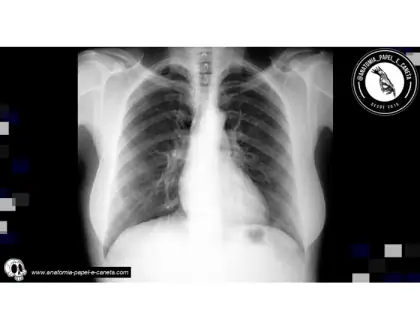 Tórax por RX - 2