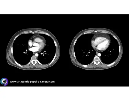 Mediastino por TC - Axial 2