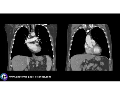 Mediastino por TC - Coronal