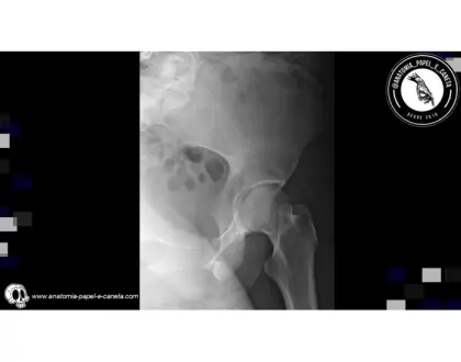 Ossos do quadril por rx - 3