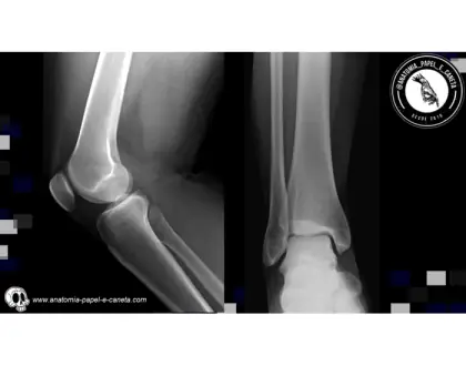 Ossos tíbia e fíbula por rx - 2